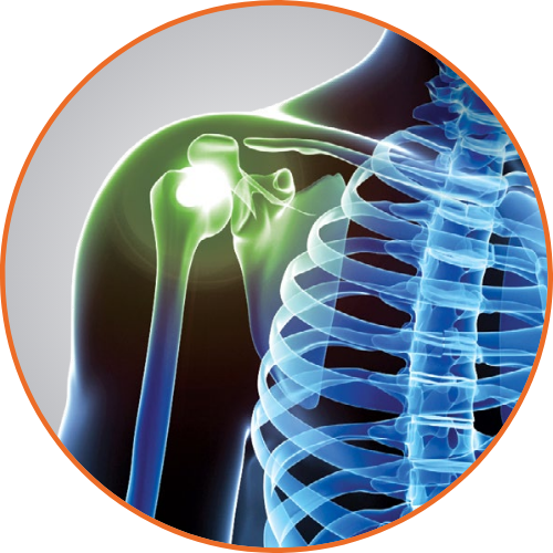 Monovisc injection therapy - Eos Active